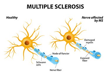 Comparison between healthy nerve and with Multiple sclerosis